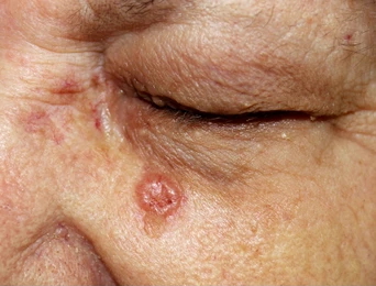 Dermatological care